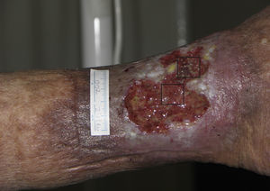 Venous ulcer in which the 2 quadrants used for the study are shown. The upper quadrant corresponded to the experimental area that received punch grafts of hair follicles of the scalp (experimental area) and the lower one to the control area that did not receive a graft (control area).