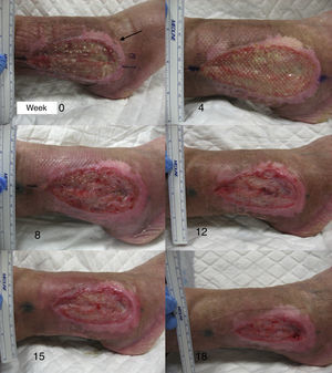 The image shows the course in one of the patients during the 18 weeks of our clinical trial. The anterior half of the ulcer received punch grafts from the scalp (experimental area), the posterior half received punch grafts from abdominal skin (control area).
