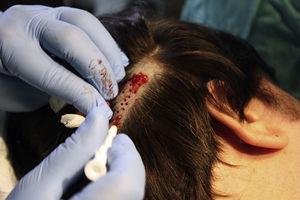 Performance of punch biopsies of scalp.