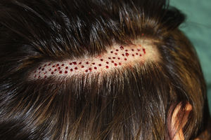 Donor area of scalp after extraction of punch biopsies.