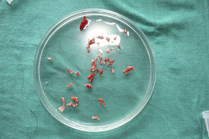 Punch biopsies of scalp in saline solution after extraction, prior to implantation.