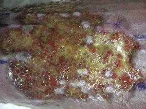 Persistence of hair shafts in the ulcer bed weeks after transplantation.
