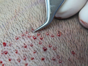 Incisions made with the punch around the follicular unit, with the hair in the center of the surface of the punch sections.