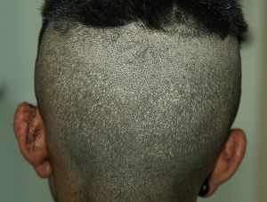 Hypopigmented pinpoint scars in the donor area of a patient who underwent follicular unit extraction with a blunt 0.9-mm punch (Harris SAFE system, HSC Development, Colorado, US).