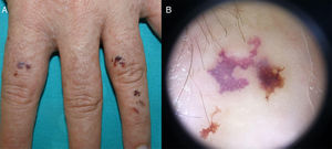 A, Hemorrhagic papules and vesicles on the dorsum of the fingers (case 2). B, Dermoscopic image of a lesion showing signs of bleeding.