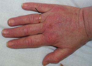 Erythematous macular lesions on the metacarpophalangeal joints and the dorsum of the fingers, with edema (the arrow indicates the pressure exerted by the patient