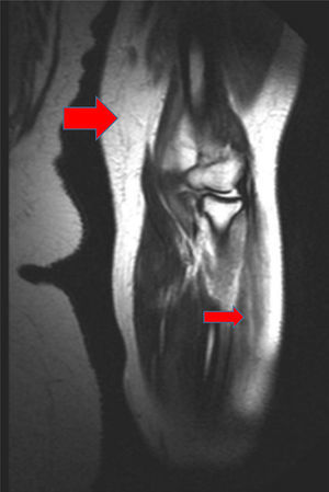Magnetic resonance image of the left arm, where a hyperintense signal in several muscle groups is compatible with myositis. It is also possible to observe edema affecting the muscle and subcutaneous cellular tissue (the large red arrow points to an affected muscle group, and the small red arrow points to an area of edema in the subcutaneous cellular tissue).