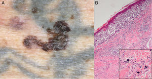 A, Melanoma on the left arm over a tattoo that is more than 60 years old. B, Histopathology of the melanoma, in which tattoo ink is visible (hematoxylin-eosin, original magnification ×4). The inset shows a more detailed image (original magnification ×40).