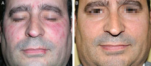 A, Clinical appearance of the lesions before treatment with a single dose of oral ivermectin (250μg/kg). B, Clinical appearance 6 months later.
