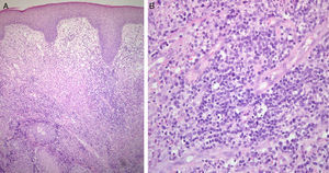 A, Dense lymphocytic infiltrate with a perivascular distribution in the mid and deep dermis, extending partially towards the epidermis and hair follicles. Edematous superficial dermis. Hyperplastic epidermis with preserved architecture and maturation. Hematoxylin and eosin, original magnification×100. B, Population of lymphocytes with scant, pale eosinophilic cytoplasm and atypical nuclei with clumped chromatin and irregular borders. Hematoxylin and eosin, original magnification×400).