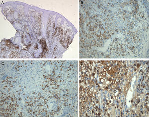 A, A CD3+ lymphoid population is present in the superficial and mid dermis, with a notable perivascular distribution. CD3 immunohistochemical stain, original magnification×25. B, Cytoplasm positive for CD56 in the perivascular neoplastic lymphocytic infiltrate. CD56 immunohistochemical stain, original magnification×200. C, Cytoplasm positive for the protease granzyme B, present in activated cytotoxic T-cells and in natural killer cells. Granzyme B immunohistochemical stain, original magnification×200. D, Nucleus of the malignant lymphocytes positive for Epstein-Barr virus mRNA. Epstein-Barr-encoded small RNAs (EBER) stain, original magnification×400.