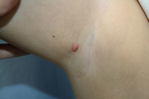 A solid yellowish-erythematous papule of 7mm diameter in the right axilla.