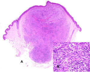 A, A diffuse histiocytic proliferation occupies the full thickness of the dermis. Hematoxylin and eosin, original magnification×20. B, At higher power, the proliferation is seen to be formed of cells with isomorphic oval nuclei and eosinophilic cytoplasm, together with foam cells, some of which are multinucleated, including occasional Touton-type cells. Hematoxylin and eosin, original magnification×400.