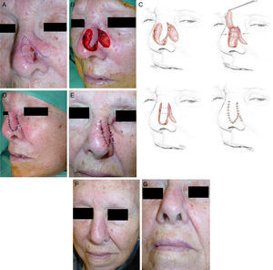 A, Basal cell carcinoma on the lateral wall of the nose. Design of the excision and of the reconstruction using a lobar transposition flap from the adjacent skin. B, Flap dissected in the subcutaneous plane, transposed to cover the defect. There is a noticeable difference between the size of the flap and the surface area of the wound. C, Series of drawings to illustrate the use of 2 guitar-string sutures to reduce the size of the defect and allow tension-free fixation of the flap. D, Result immediately after suturing with 6/0 silk. E, Appearance at 24hours. F and G, Final outcome 2 months after surgery.