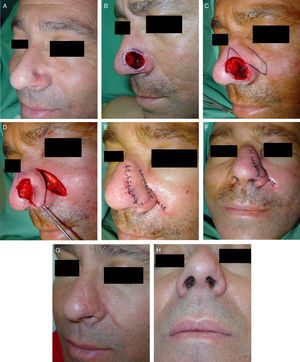 A, Male patient with carcinoma on the lateral wall of the nose that had recurred after previous surgery and radiotherapy, referred to perform 3-dimensional histologic study. B, Initial defect, with marking of the affected margins after histologic study of all the excision margins. C, Design of a lobar transposition flap on the skin superior to the defect, extending towards the nasolabial sulcus. D, Definitive defect after the final stage at the inferior part of the defect, close to the free border of the ala, and flap dissected along a deep plane. Transposition and rotation movement of the flap with the aid of a hook. E and F, Final outcome after transposition of the flap and suturing of the skin with 6/0 silk. Previously, the area of the wound had been reduced using a guitar-string suture. G and H, Final outcome 6 months after surgery.