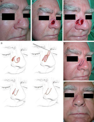 A, Basal cell carcinoma on the lateral wall of the nose. B, Final defect and design of the method of reconstruction using a lobar transposition flap of skin from the nasofacial angle. B, Flap dissected in the subcutaneous plane, transposed to cover the defect. D, The diagrams illustrate approximation of the borders of the defect using 2 guitar-string sutures, the reduction in the surface area of the wound, and the final position of the lobar flap. E, Result immediately after suturing with 6/0 silk. E, Appearance at 24hours.