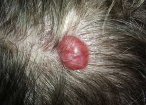 Cylindroma on the scalp.