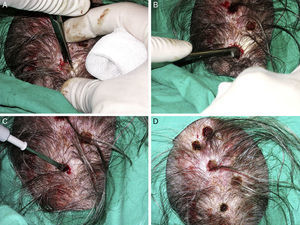A, Incision and debulking. B, Curettage. C, Electrocautery to stop bleeding. D, Immediate postoperative findings.