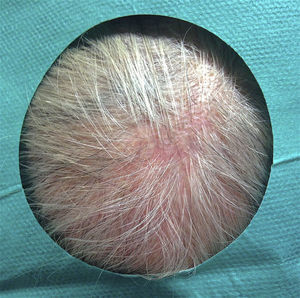 Outcome 12 months after surgery.