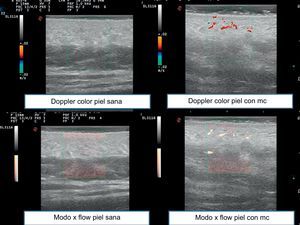 Ultrasound images comparing color Doppler in healthy skin and skin with capillary malformations and X flow in healthy skin and skin with capillary malformations. CM indicates capillary malformations.