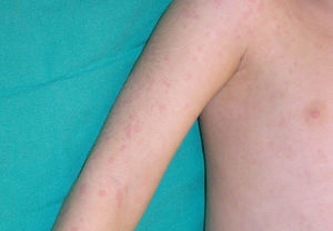 NOMID (neonatal-onset multisystem inflammatory disease). Permanent urticaria-like migratory eruption.