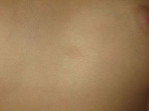 Plaque-type neural proliferation on the chest of a patient with neurofibromatosis type 2. A slightly more pigmented area of skin is observed with hypertrichosis on the surface.