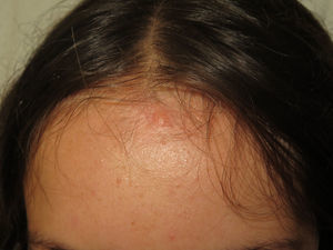 Plaque-type neural proliferation on the forehead of a patient with neurofibromatosis type 2.
