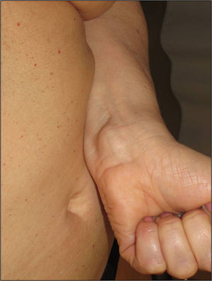 Plaque-type neural proliferation on the anterior face of the wrist of a patient with neurofibromatosis type 2.