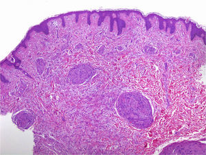 Neural proliferation with plexiform schwannoma pattern. Staining with hematoxylin-eosin ×100.