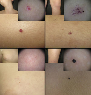Distinct vascular lesions in our first patient. A, Cherry angioma on the right leg, with vascular lacunae and desquamating collarettes in the dermoscopic image. B, Capillary malformation on the left leg with a dotted vascular dermoscopic pattern. C, Capillary malformation with a reticulated vascular dermoscopic pattern. D, Angiokeratoma-like lesion with a dark lacuna in the dermoscopic image.
