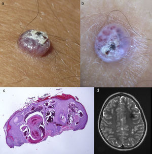 A, Angiokeratoma on the knee. B, Dermoscopic image with vascular lacunae and a superficial scab. C, Histology showing vessels with fibrin thrombi in the dermis and epidermal hyperplasia. Hematoxylin and eosin, original magnification×4. D, Axial T2-weighted cerebral magnetic resonance image: cerebral cavernous malformation.