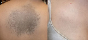 Noninfiltrated bluish macular plaque with no nodules and irregular borders and peripheral brown areas on the center of the back (13.5×10.5cm) (A) and with less evident grayish-blue coloring on the right hemithorax (B).