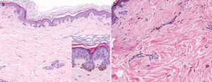 A, Findings from a biopsy specimen taken from the wrist. Note the lentiginous epidermal hyperplasia with hyperpigmented bulbous projections of the epidermal rete ridges and increased basal melanocytes (hematoxylin-eosin [H-E], original magnification ×10; detail (inset), original magnification ×40). B, Findings from a biopsy specimen taken from the back. Notice the dendritic melanocytes in the reticular and papillary dermis and hyperpigmentation of the basal layer of the epidermis (H-E, original magnification ×20).
