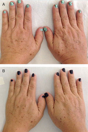 Dorsal surfaces of treated hands. A, Before treatments with platelet-rich plasma. B, After treatments.