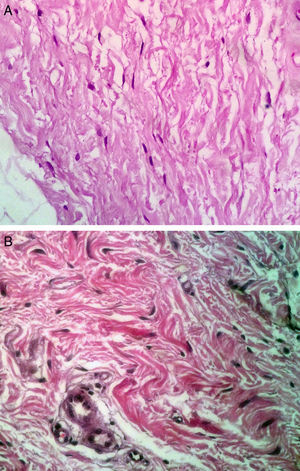 Histologic features of biopsied tissue; hematoxylin and eosin, original magnification ×40. A, After treatments with platelet-rich plasma the number of fibroblasts increased. B, Before treatments.