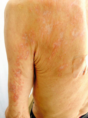 Erythematous-brownish nodular lesions with central scarring. The lesions are limited to the areas affected by varicella-zoster virus reactivation 2 years earlier (left scapular region).