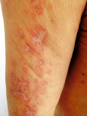 Erythematous-brownish nodular lesions with central scarring. The lesions were limited to the areas affected by varicella-zoster virus reactivation 2 years earlier (left arm).