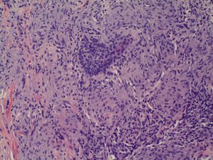 Sarcoid-type granuloma in the dermis. Hematoxylin and eosin, original magnification×20.
