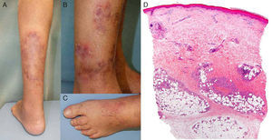A, Nodules beneath erythematous plaques with peripheral desquamation. B, In greater detail, showing the residual hyperpigmentation. C, Edema on the dorsum of the left foot. D, Skin biopsy showing a normal epidermis and dermis, with lesions in the subcutaneous cellular tissue. Inflammatory infiltrate in the septa. Hematoxylin and eosin, original magnification×4.