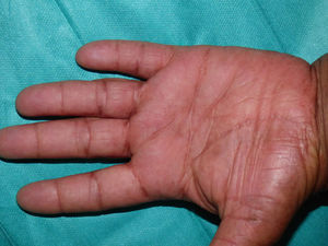 Punctate keratosis confined to the palmar creases.