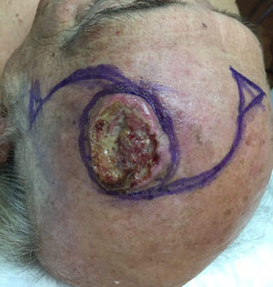 The O-Z flap for scalp defects. Photograph courtesy of Dr. Alfonso Liaño.