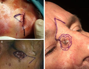 A, The Tenzel flap for the lower eyelid. B, The Limberg flap for the lateral canthus of the eye. C, The glabellar flap for the medial canthus of the eye.