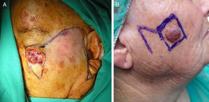 A, The Mustardé flap for the infraorbital cheek. B, The Limberg flap was the flap of choice for the zygomatic, buccal, and parotid-masseteric subunits of the cheek. Photographs courtesy of Dr. Antonio Ramírez Andreo.