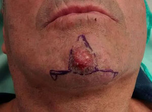 A-T flap for the chin. Photograph courtesy of Dr. Ana Miragaya.