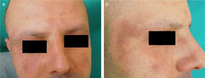 Clinical examination shows irregular areas of reddish-brown pigmentation of the cheeks, temples, lateral aspects of the nose, and frontal area (a and b).