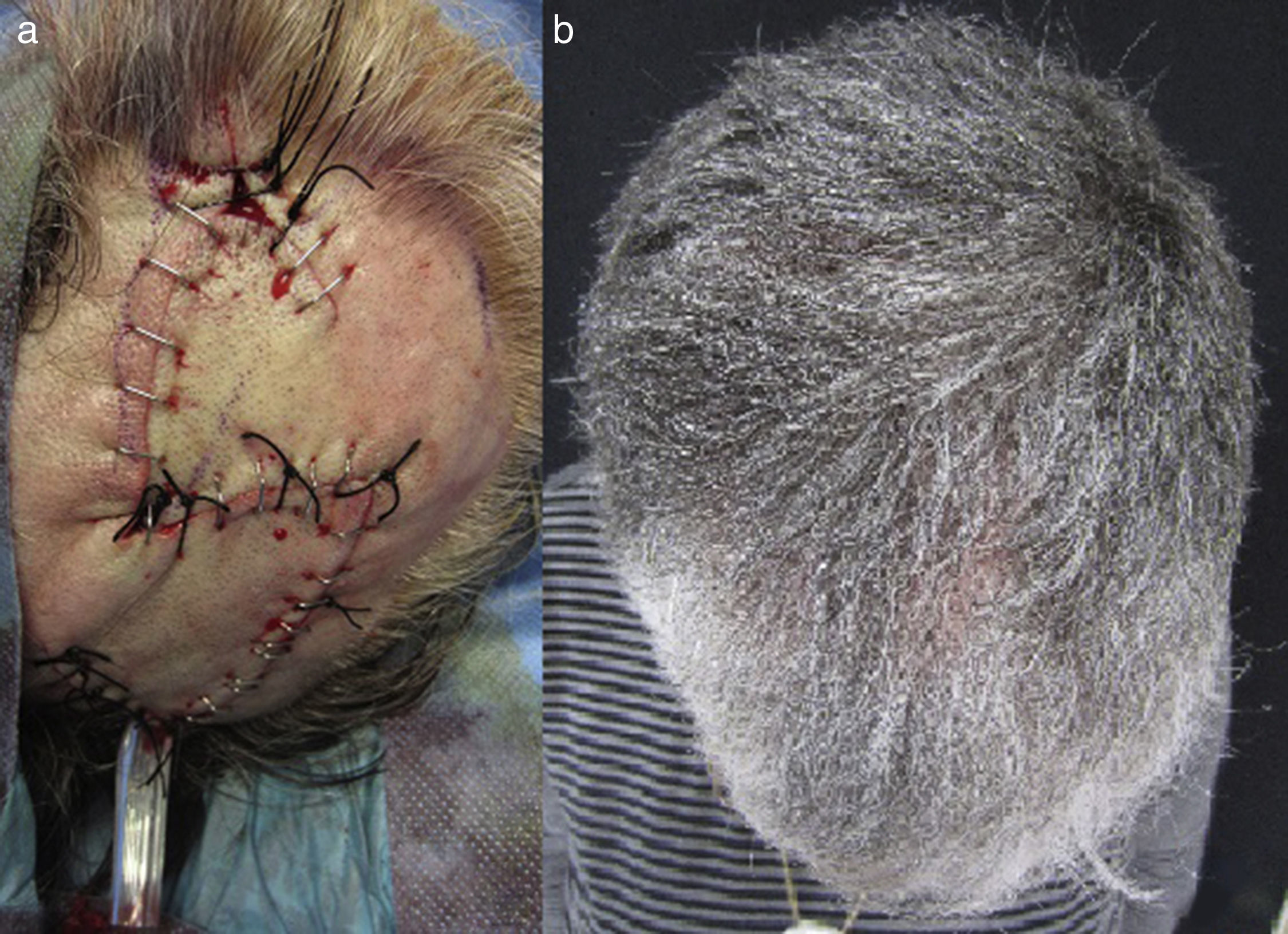 Double Hatchet Flap For The Reconstruction Of Scalp Defects Actas DermoSifiliográficas