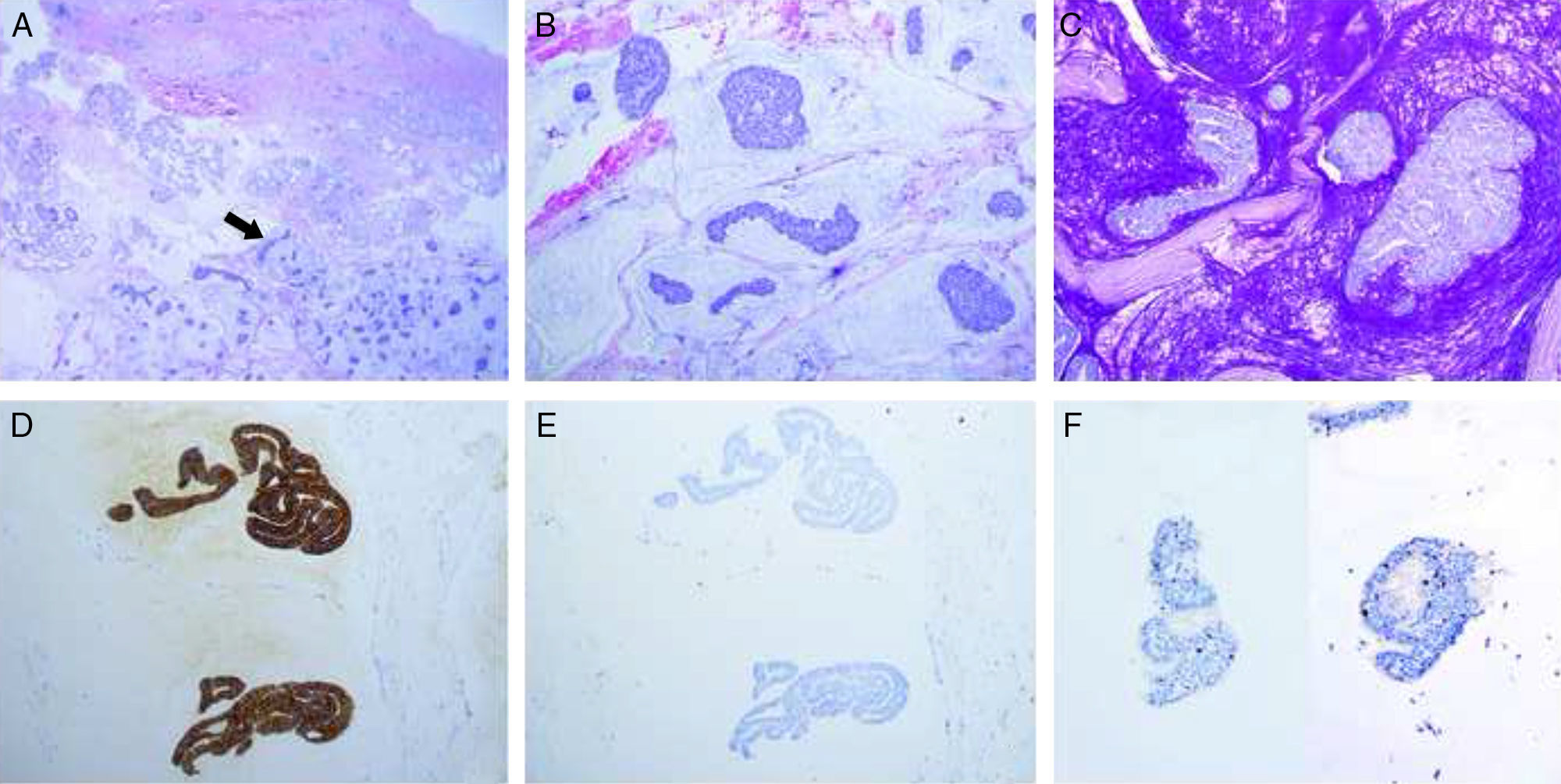 Primary Mucinous Carcinoma of the Skin: A Case Report | Actas Dermo ...