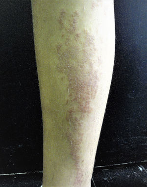 Clinical photograph of a patient with lichen striatus.