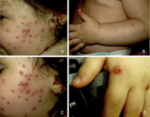 A, Erythematous-orange papules, some of which are umbilicated and show pseudovesiculation and the presence of scabs. B and C, A week later, all the lesions were in the papular phase, and yellow-orange papules had appeared on the forearms. D, Bullous lesions on the hands 2 months after onset of the condition.