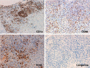 Immunohistochemistry: A, Extensive and diffuse positivity for CD1a. Original magnification×100. B and C, Detail of the nodules showing scattered but extensive positivity for CD68 and S100 in the epidermis, interstitial dermis, and dermal nodules. Original magnification×200. D, Detail of the nodules showing weak positivity for langerin in the same areas that were positive for CD1a, CD68, and S100. Original magnification×200.
